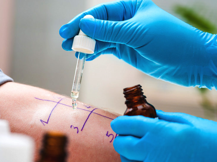 What Are the Different Types of Allergy Tests?